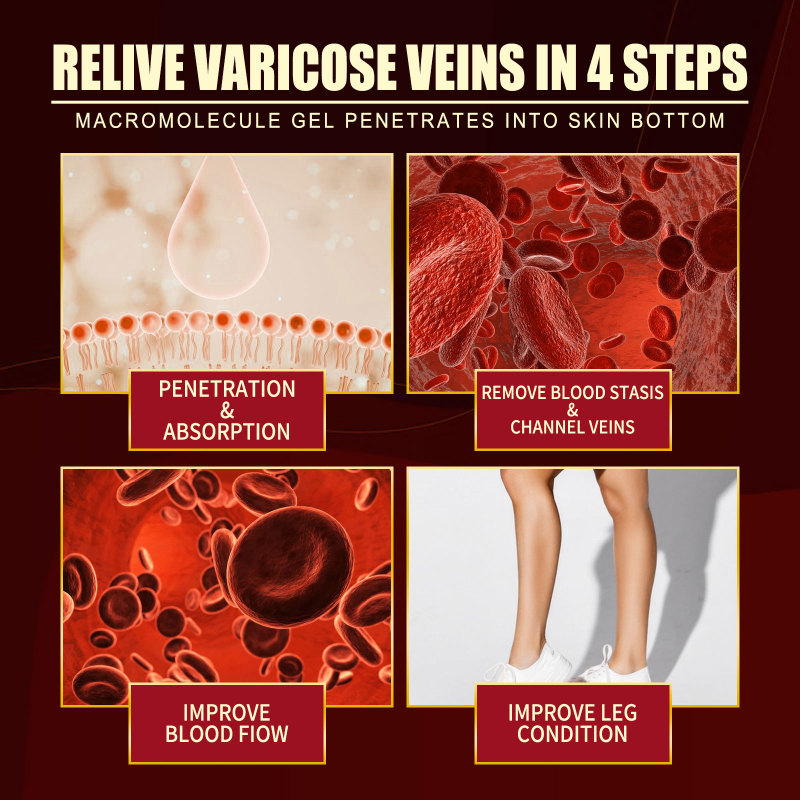 South Moon Vein Repair Agent Varicose Massage Relieves Earthworm Leg Repair Soreness And Swelling Body Care - Image 3