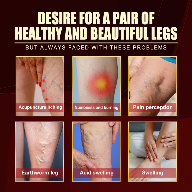 South Moon Vein Repair Agent Varicose Massage Relieves Earthworm Leg Repair Soreness And Swelling Body Care - Image 4