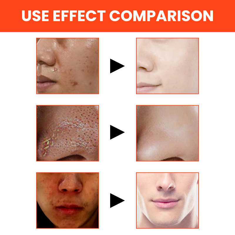 East Moon Men's Volcanic Face Wash, Acne Blackhead Face Deep Clean Pores And Oil Control - Image 3