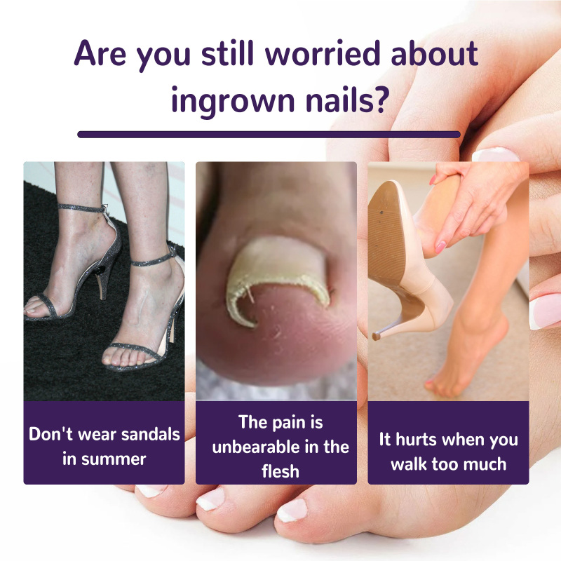 EELHOE Elastic Toenail Correction Patch, Nail Groove Correction Nail Repair Ingrown Nail Patch - Image 3