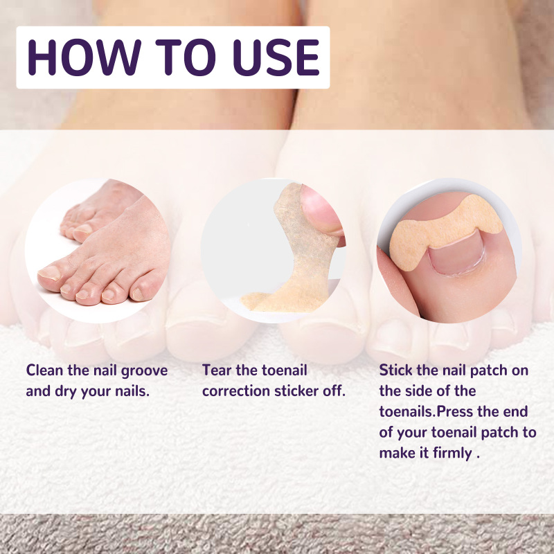 EELHOE Elastic Toenail Correction Patch, Nail Groove Correction Nail Repair Ingrown Nail Patch - Image 6