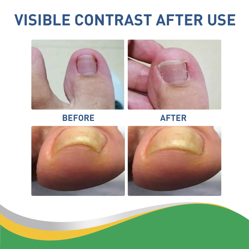 Jaysuing Toenail Furrow Correction, Toenail Insert Nail Repair Correction Pull-up Nail Nail Patch - Image 3