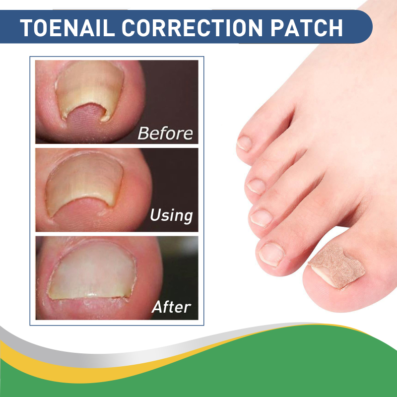 Jaysuing Toenail Furrow Correction, Toenail Insert Nail Repair Correction Pull-up Nail Nail Patch - Image 4