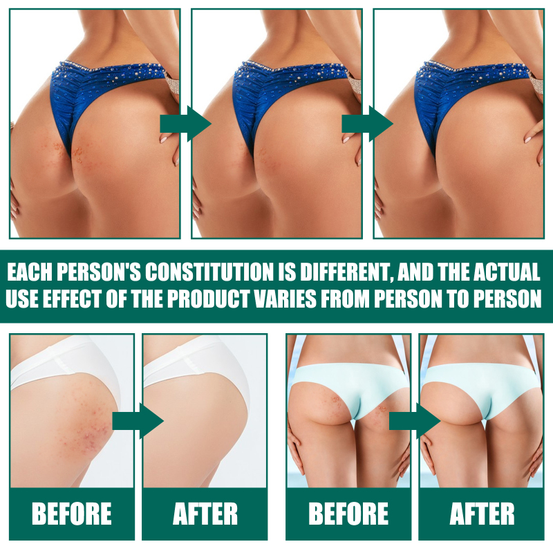 Jaysuing This Buttock Care Cream, Refreshing, Moisturizing Texture And Mild Ingredients. It Is A Body Cream That Provides Comfortable Care For Acne On The Buttocks - Image 3