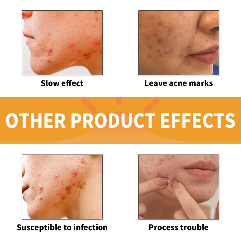 Jaysuing Facial Care Patch: Gentle Ingredients Nourish Facial Skin, Cover Acne, Moisturize, Be Lightweight And Breathable. - Image 3