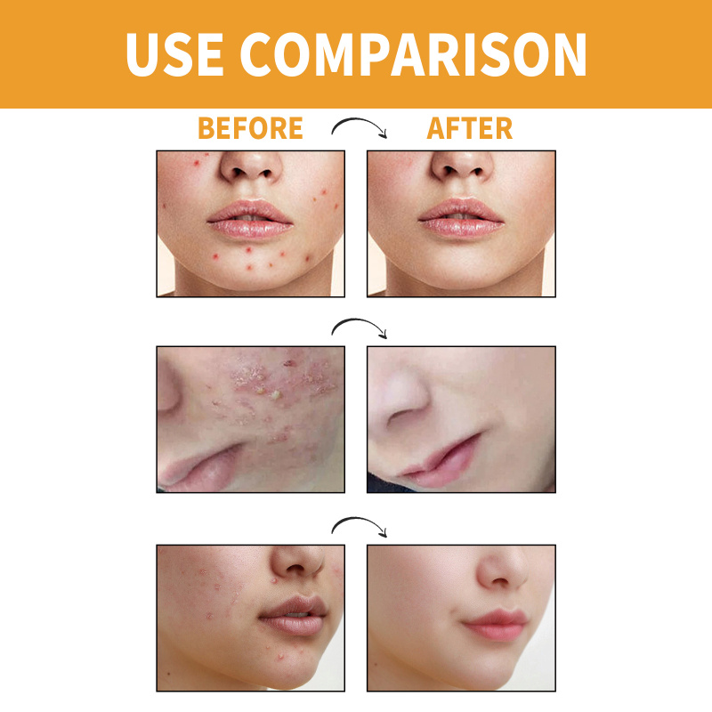 Jaysuing Facial Care Patch: Gentle Ingredients Nourish Facial Skin, Cover Acne, Moisturize, Be Lightweight And Breathable. - Image 4
