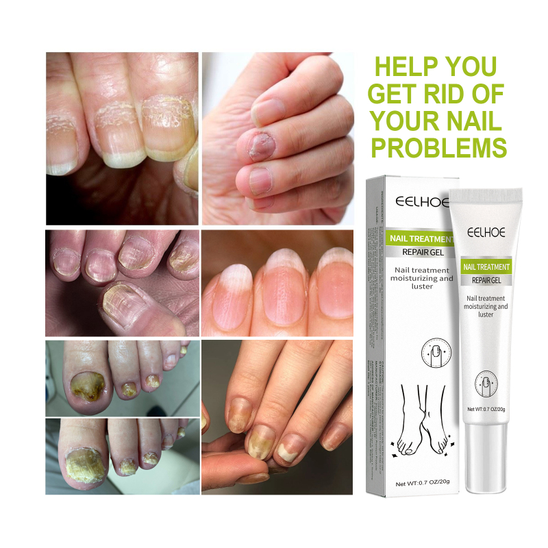 EELHOE Hand, Foot And Nail Repair, Soft Nail Polish Polish Gel - Image 4