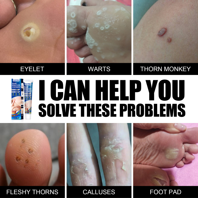 South Moon Wart Remover Cream, Grains Neck Filamentous Brothers Face Alar Tame Hou Warts - Image 3