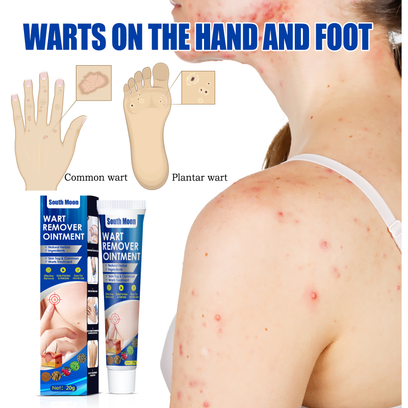 South Moon Wart Remover Cream, Grains Neck Filamentous Brothers Face Alar Tame Hou Warts - Image 4