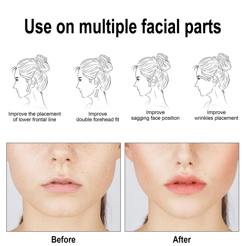 EELHOE Facial Lifting Patch, Lift Face Double Chin V Face Melon Seed Face Invisible Lifting Patch - Image 6