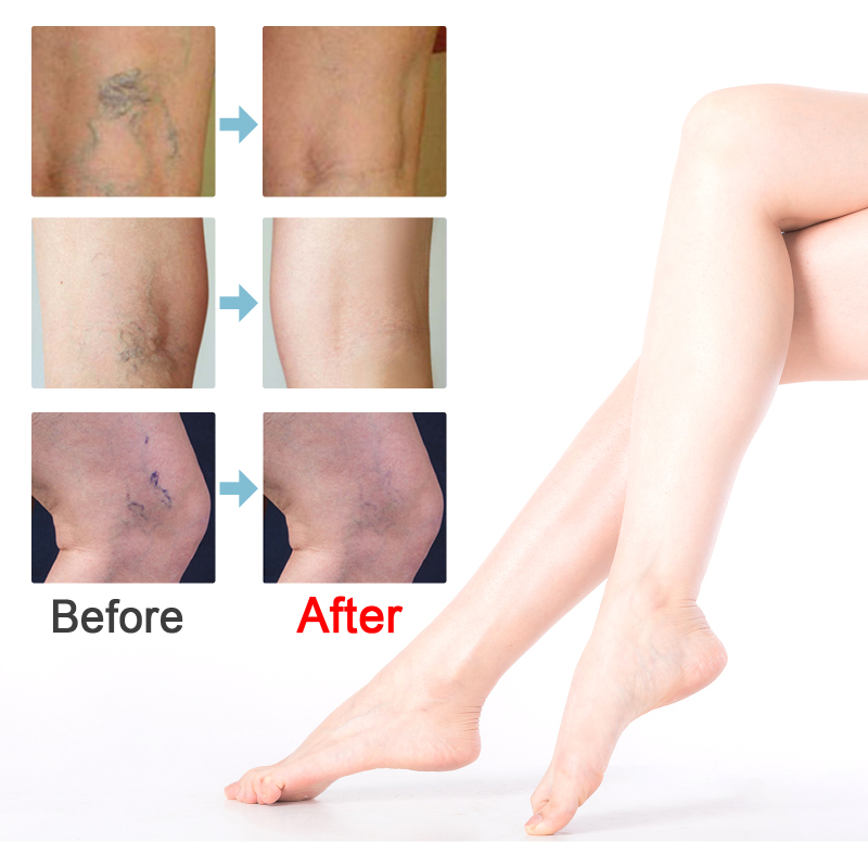 South Moon Leg Care Patch, Waterproof Breathable Skin Care Patch For Legs - Image 4
